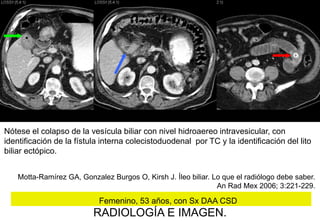 Nótese el colapso de la vesícula biliar con nivel hidroaereo intravesicular, con
identificación de la fístula interna colecistoduodenal por TC y la identificación del lito
biliar ectópico.
Motta-Ramírez GA, Gonzalez Burgos O, Kirsh J. Íleo biliar. Lo que el radiólogo debe saber.
An Rad Mex 2006; 3:221-229.

Femenino, 53 años, con Sx DAA CSD

RADIOLOGÍA E IMAGEN.

 
