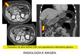 Femenino, 65 años SxDAA CSD, con pseudotumor inflamatorio gástrico

RADIOLOGÍA E IMAGEN.

 