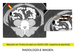 Masculino de 19 años de edad con SxDAA CSD, sospecha de apendicitis

RADIOLOGÍA E IMAGEN.

 