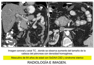 Imagen coronal y axial TC , donde se observa aumento del tamaño de la
cabeza del páncreas con densidad homogénea.
Masculino de 64 años de edad con SxDAA CSD y sindrome icterico

RADIOLOGÍA E IMAGEN.

 