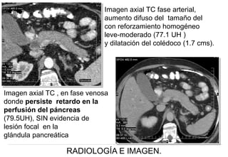 Imagen axial TC fase arterial,
aumento difuso del tamaño del
con reforzamiento homogéneo
leve-moderado (77.1 UH )
y dilatación del colédoco (1.7 cms).

Imagen axial TC , en fase venosa
donde persiste retardo en la
perfusión del páncreas
(79.5UH), SIN evidencia de
lesión focal en la
glándula pancreática

RADIOLOGÍA E IMAGEN.

 