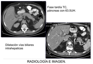Fase tardía TC,
páncreas con 63.5UH.

Dilatación vías biliares
intrahepaticas

RADIOLOGÍA E IMAGEN.

 