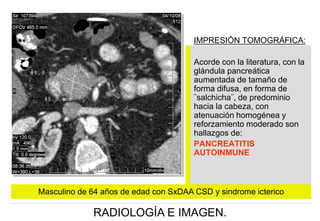 IMPRESIÓN TOMOGRÁFICA:
Acorde con la literatura, con la
glándula pancreática
aumentada de tamaño de
forma difusa, en forma de
¨salchicha¨, de predominio
hacia la cabeza, con
atenuación homogénea y
reforzamiento moderado son
hallazgos de:
PANCREATITIS
AUTOINMUNE

Masculino de 64 años de edad con SxDAA CSD y sindrome icterico

RADIOLOGÍA E IMAGEN.

 