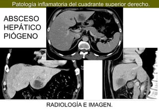 Patología inflamatoria del cuadrante superior derecho.

ABSCESO
HEPÁTICO
PIÓGENO

RADIOLOGÍA E IMAGEN.

 