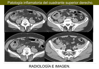 Patología inflamatoria del cuadrante superior derecho.

RADIOLOGÍA E IMAGEN.

 