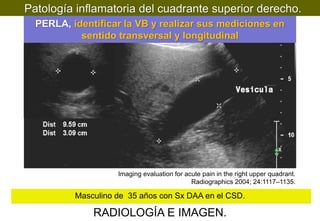 Patología inflamatoria del cuadrante superior derecho.
PERLA, identificar la VB y realizar sus mediciones en
sentido transversal y longitudinal

Imaging evaluation for acute pain in the right upper quadrant.
Radiographics 2004; 24:1117–1135.

Masculino de 35 años con Sx DAA en el CSD.

RADIOLOGÍA E IMAGEN.

 