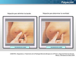 Palpación

Palpación para delimitar los bordes

Palpación para determinar la movilidad

CENETEC. Diagnóstico y Tratamiento de la Patología Mamaria Benigna en el Primer y Segundo Nivel de atención.
México, Secretaria de Salud 2009

 
