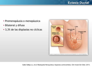 Ectasia Ductal

 Premenopáusia o menopáusica
 Bilateral y difusa

 3,3% de las displasias no cíclicas

Gallo Vallejo JL, et al. Mastopatía fibroquística. Aspectos controvertidos. Clin Invest Gin Obst. 2013.

 