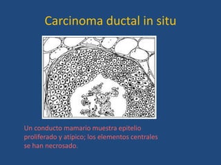 Carcinoma ductal in situ




Un conducto mamario muestra epitelio
proliferado y atípico; los elementos centrales
se han necrosado.
 