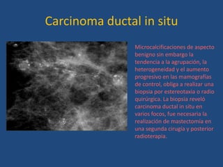 Carcinoma ductal in situ
                Microcalcificaciones de aspecto
                benigno sin embargo la
                tendencia a la agrupación, la
                heterogeneidad y el aumento
                progresivo en las mamografías
                de control, obliga a realizar una
                biopsia por estereotaxia o radio
                quirúrgica. La biopsia reveló
                carcinoma ductal in situ en
                varios focos, fue necesaria la
                realización de mastectomía en
                una segunda cirugía y posterior
                radioterapia.
 