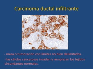 Carcinoma ductal infiltrante




- masa o tumoración con límites no bien delimitados.
- las células cancerosas invaden y remplazan los tejidos
circundantes normales.
 