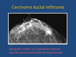 Carcinoma ductal infiltrante




alto grado nuclear con importante estroma-
reacción provocando distorsión arquitectural.
 