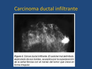 Carcinoma ductal infiltrante
 