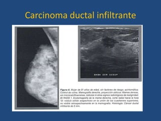 Carcinoma ductal infiltrante
 