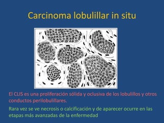 Carcinoma lobulillar in situ




El CLIS es una proliferación sólida y oclusiva de los lobulillos y otros
conductos perilobulillares.
Rara vez se ve necrosis o calcificación y de aparecer ocurre en las
etapas más avanzadas de la enfermedad
 