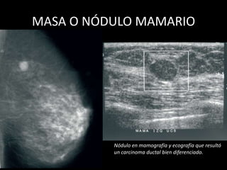 MASA O NÓDULO MAMARIO




          Nódulo en mamografía y ecografía que resultó
          un carcinoma ductal bien diferenciado.
 