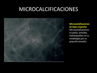 MICROCALCIFICACIONES

                 Microcalcificaciones
                 de baja sospecha
                 Microcalcificaciones
                 en polvo, amorfas,
                 indistinguibles en su
                 morfología por su
                 pequeño tamaño.
 