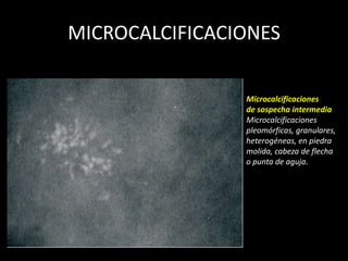 MICROCALCIFICACIONES

                Microcalcificaciones
                de sospecha intermedia
                Microcalcificaciones
                pleomórficas, granulares,
                heterogéneas, en piedra
                molida, cabeza de flecha
                o punta de aguja.
 