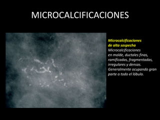 MICROCALCIFICACIONES

               Microcalcificaciones
               de alta sospecha
               Microcalcificaciones
               en molde, ductales finas,
               ramificadas, fragmentadas,
               irregulares y densas.
               Generalmente ocupando gran
               parte o todo el lóbulo.
 