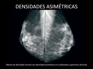 DENSIDADES ASIMÉTRICAS




Mama de densidad normal con densidad asimétrica en cuadrantes superiores derecha.
 