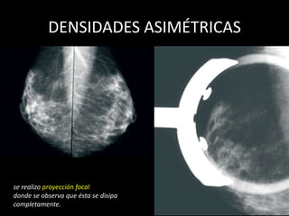 DENSIDADES ASIMÉTRICAS




se realizo proyección focal
donde se observa que ésta se disipa
completamente.
 