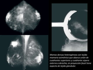 Mamas densas heterogéneas con tejido
mamario asimétrico que abarca unión de
cuadrantes superiores y cuadrante súpero
externo a derecha, en proyección focal tiene
aspecto de tejido glandular.
 