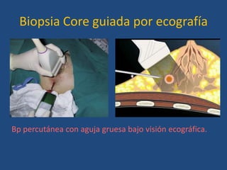 Biopsia Core guiada por ecografía




Bp percutánea con aguja gruesa bajo visión ecográfica.
 