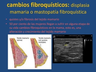 cambios fibroquísticos: displasia
   mamaria o mastopatía fibroquística
• quistes y/o fibrosis del tejido mamario
• 50 por ciento de las mujeres llegan a sufrir en alguna etapa de
  su vida cambios fibroquísticos en la mama, esto es, una
  alteración y crecimiento del tejido mamario
 