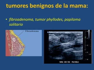 tumores benignos de la mama:

• fibroadenoma, tumor phyllodes, papiloma
  solitario
 