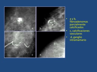 • a y b,
  fibroadenomas
  parcialmente
  calcificados
• c, calcificaciones
  vasculares
• d, ganglio
  intramamario
 