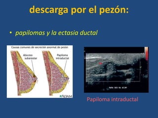 descarga por el pezón:

• papilomas y la ectasia ductal




                           Papiloma intraductal
 