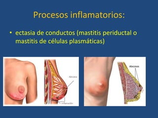 Procesos inflamatorios:
• ectasia de conductos (mastitis periductal o
  mastitis de células plasmáticas)
 