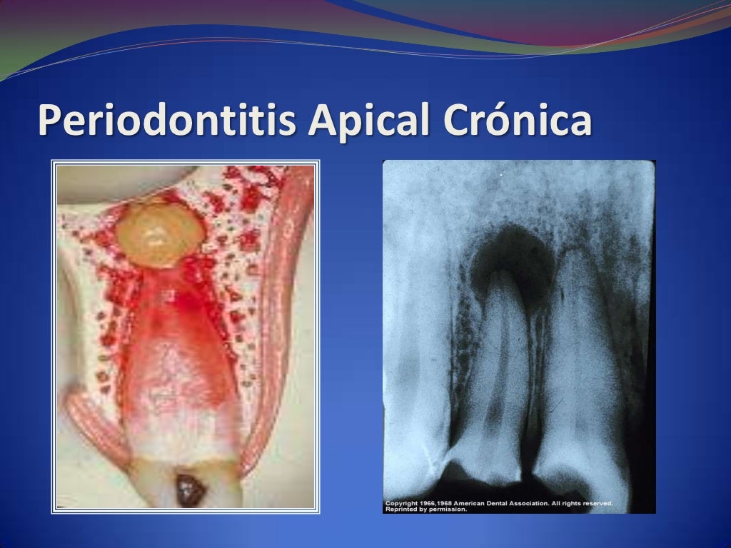 Patología periapical