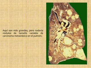 Aquí son más grandes, pero todavía
nódulos de tamaño variable de
carcinoma metastásico en el pulmón.
 