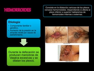 Etiología: 
• Componente familiar o 
genético. 
• Aumento de la presión en la 
ampolla rectal por causa de 
estreñimiento. 
Durante la defecación se 
producen maniobras de 
Vasalva excesivas y se 
dilatan los plexos. 
Consiste en la dilatación varicosa de los plexos 
venosos hemorroidales. Dependiendo si afecta al 
plexo inferior o superior hablaremos de 
hemorroides internas o externas. 
 