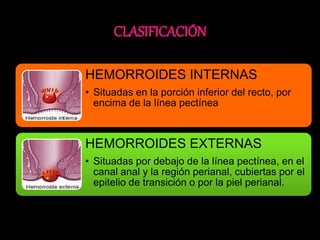 HEMORROIDES INTERNAS 
• Situadas en la porción inferior del recto, por 
encima de la línea pectínea 
HEMORROIDES EXTERNAS 
• Situadas por debajo de la línea pectínea, en el 
canal anal y la región perianal, cubiertas por el 
epitelio de transición o por la piel perianal. 
 