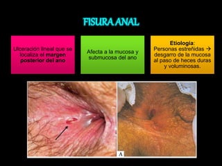 Ulceración lineal que se 
localiza el margen 
posterior del ano 
Afecta a la mucosa y 
submucosa del ano 
Etiología: 
Personas estreñidas  
desgarro de la mucosa 
al paso de heces duras 
y voluminosas. 
 