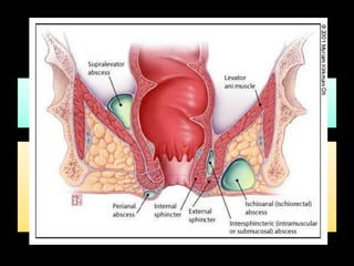 Etiología: 
• Infección de las criptas ano-rectales 
• Acumulación material purulento que puede extenderse entre los 
planos anatómicos 
Clasificación 
• Absceso Pelvi-Rectal: sigue un trayecto ascendente entre 
esfínter interno y el músculo elevador. 
• Absceso InterEsfinteriano: Se localiza entre el esfínter interno y 
externo. 
• Absceso Isquio-Rectal: Si el pus se va por fuera del esfínter 
externo. 
• Absceso Perianal: Si el pus acumula en los márgenes del ano. 
 