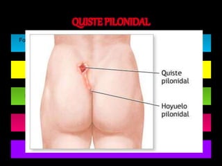 Formación en la región sacro-coxígea con material purulento y pelos en su 
interior, 
Generalmente sintomático. 
Motivo de consulta: Fistuliza al exterior dando una secreción crónica 
Diagnóstico: Inspección 
Tratamiento: Extirpación quirúrgica 
 