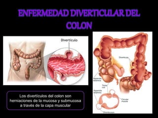 Los divertículos del colon son 
herniaciones de la mucosa y submucosa 
a través de la capa muscular 
 