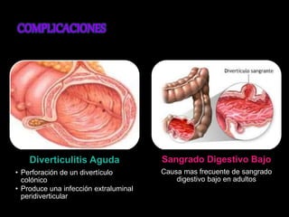 Diverticulitis Aguda 
• Perforación de un divertículo 
colónico 
• Produce una infección extraluminal 
peridiverticular 
Sangrado Digestivo Bajo 
Causa mas frecuente de sangrado 
digestivo bajo en adultos 
 