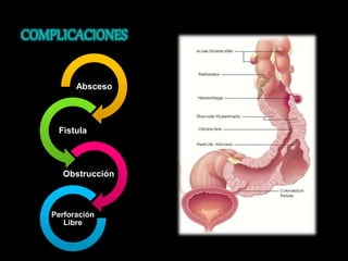 Absceso 
Fistula 
Obstrucción 
Perforación 
Libre 
 