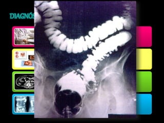 Buena 
• Historia clínica. 
No se Realiza Por Riesgo a Perforación 
• Colon por enema con doble contraste 
• Colonoscopia. 
¿Absceso? 
• Tomografía 
• Resonancia Magnética. 
Cede El Proceso Agudo 
• Paciente esta asintomático 
• Indicar un colon por enema con doble contraste. 
 