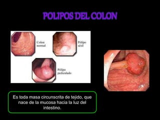 Es toda masa circunscrita de tejido, que 
nace de la mucosa hacia la luz del 
intestino. 
 