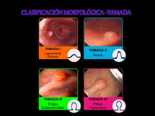 YAMADA I 
Ligeramente 
Elevada 
YAMADA II 
Sessil 
YAMADA III 
Polipo 
Subpediculado 
YAMADA IV 
Pólipo 
Pediculado 
 