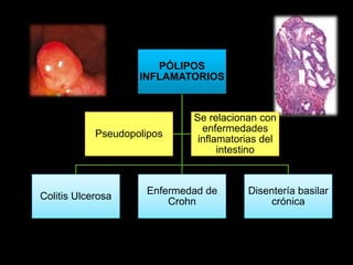 PÓLIPOS 
INFLAMATORIOS 
Colitis Ulcerosa 
Enfermedad de 
Crohn 
Disentería basilar 
crónica 
Pseudopolipos 
Se relacionan con 
enfermedades 
inflamatorias del 
intestino 
 