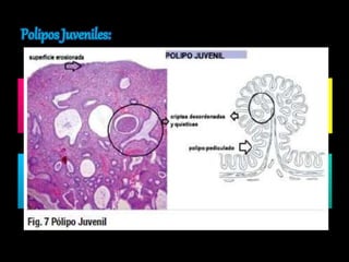 Más frecuente en 
edad pediátrica. 
No son premalignos Son de gran tamaño 
Su principal síntoma 
es sangrado. 
Son los únicos que 
pueden sufrir 
autoamputación. 
Ocasionalmente 
producen 
intususcepción. 
 