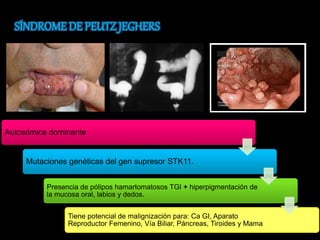 Autosómica dominante 
Mutaciones genéticas del gen supresor STK11. 
Presencia de pólipos hamartomatosos TGI + hiperpigmentación de 
la mucosa oral, labios y dedos. 
Tiene potencial de malignización para: Ca GI, Aparato 
Reproductor Femenino, Vía Biliar, Páncreas, Tiroides y Mama 
 