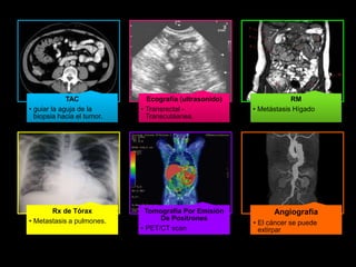 TAC 
• guiar la aguja de la 
biopsia hacia el tumor. 
Ecografía (ultrasonido) 
• Transrectal - 
Transcutáanea. 
RM 
• Metástasis Hígado 
Rx de Tórax 
• Metastasis a pulmones. 
Tomografía Por Emisión 
De Positrones 
• PET/CT scan 
Angiografía 
• El cáncer se puede 
extirpar 
 