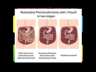 El colon y el recto son 
retirados dejando el 
canal anal y los 
músculos del esfínter. 
Se crea un recto artificial 
(bolsa) a partir de la 
parte inferior del 
intestino delgado. 
La bolsa se une al ano, 
de manera que puedan 
controlarse las acciones 
intestinales. 
Normalmente esta 
operación se realiza en 
dos etapas 
 